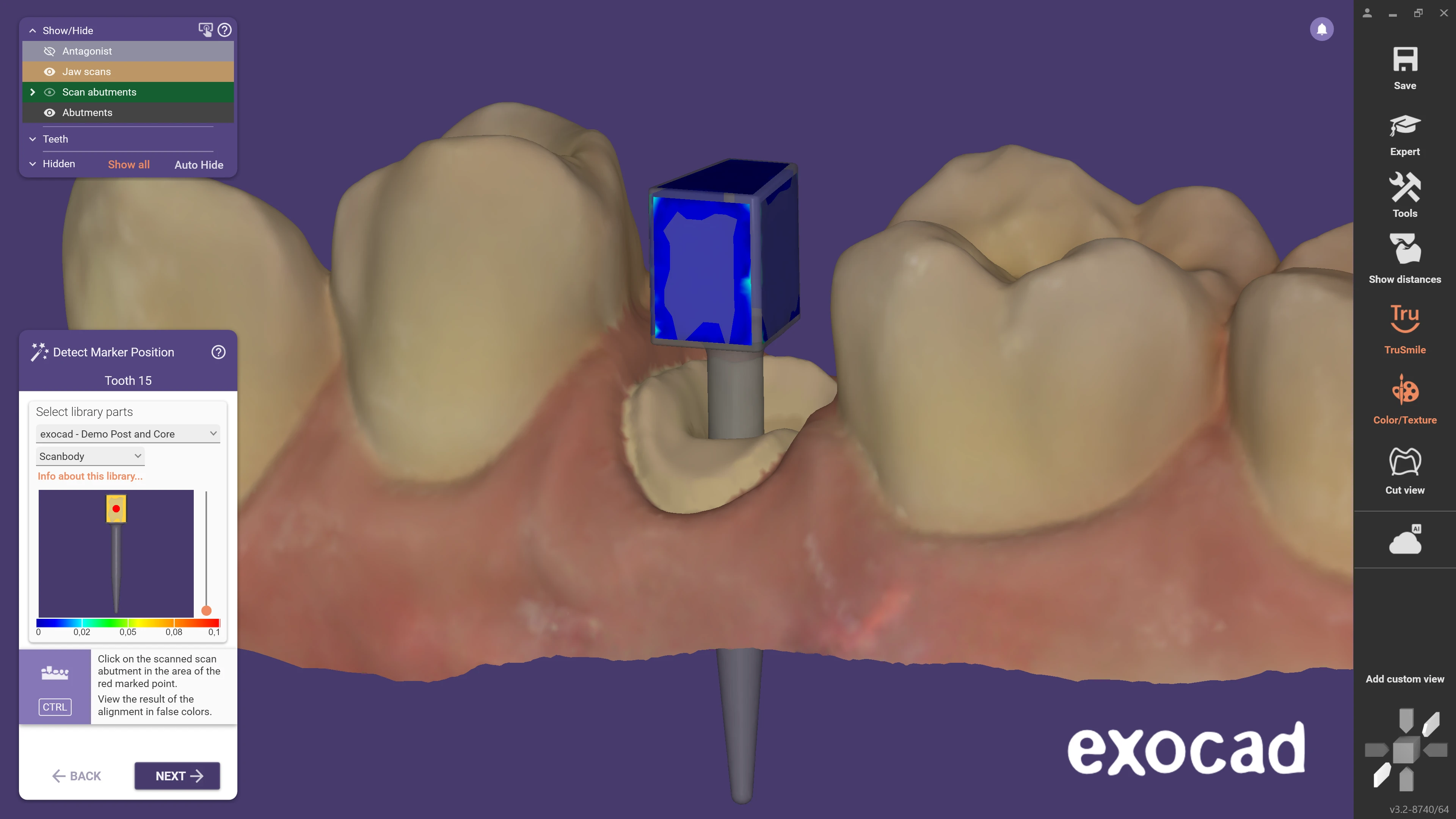 exocaddentalcadelefsinapage15postandcore